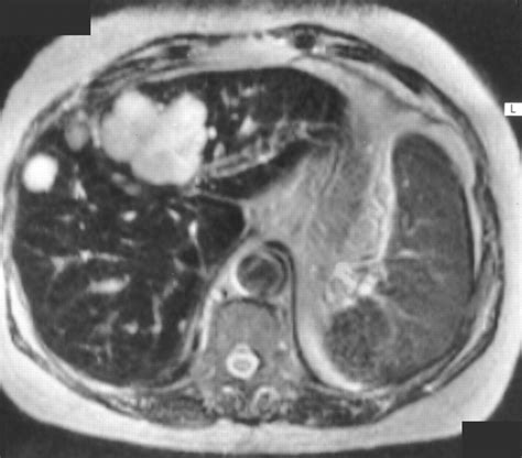 Characterization Of Focal Hepatic Lesions With Ferumoxides Enhanced T