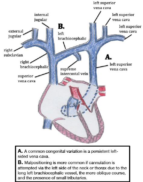 Common Variants Of Clinical Significance In The Central Venous Anatomy