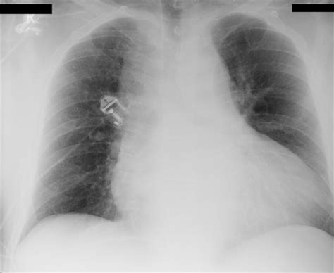 Chest X Ray Showing A Widened Mediastinum And A Striking Large Heart Shadow Download