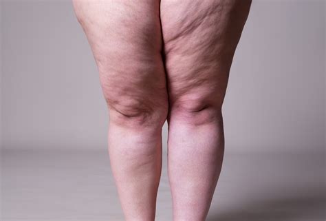 O Que Lipedema Como Identificar Esta Condi O Complexa