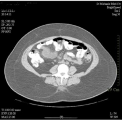 Figure 1 from Meckel’s Diverticulitis Secondary To ActinomycosisCase Report And Review Of The ...