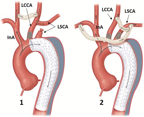 Image Predictors Of Treatment Outcome After Thoracic Aortic Dissection Repair Radiographics