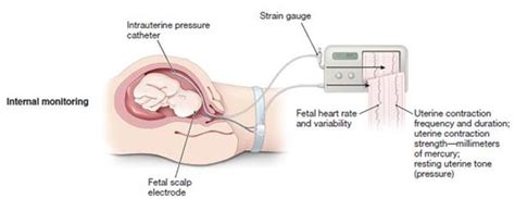 Abnormal Labor And Intrapartum Fetal Surveillance Obstetrics And