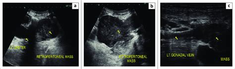 A C Ultrasound Abdomen Showing Retroperitoneal Mass Of Heterogeneous