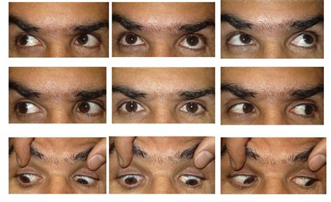 Table 1 From Paradoxical Head Tilt In Unilateral Traumatic Superior