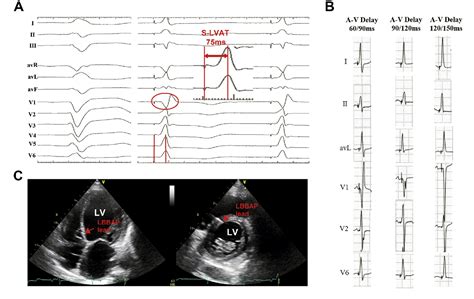 Figure From Cardiac Resynchronization Therapy By Left Bundle Branch