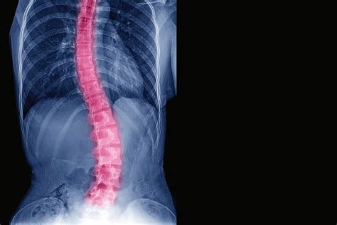 Escoliosis Patología desviación de la Columna Vertebral