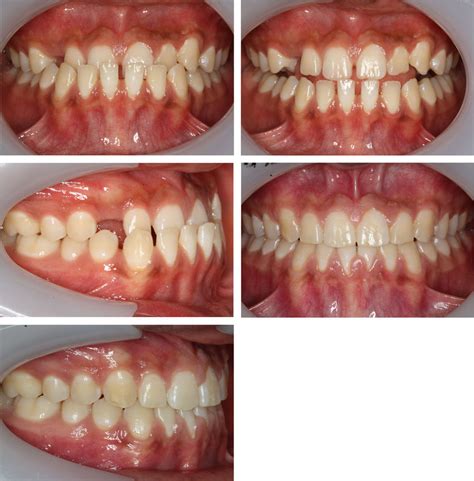 Class Iii Malocclusion Definition Sherice Haney