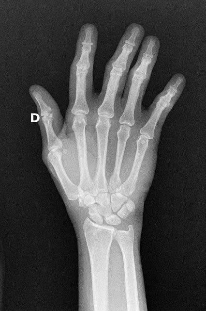 Scaphoid Fracture Middle Third Image