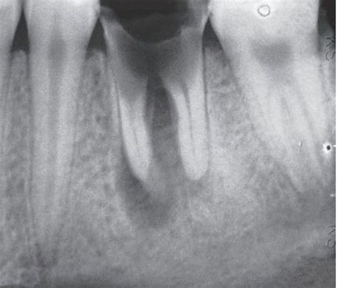 Periapical Cyst Associated With A Carious Tooth MEDizzy