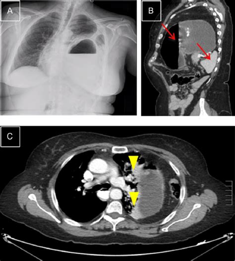 Left Diaphragmatic Hernia A Chest X Ray With Visceral Herniation In Download Scientific