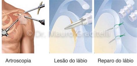 Luxação Do Ombro — Dr Mauro Gracitelli