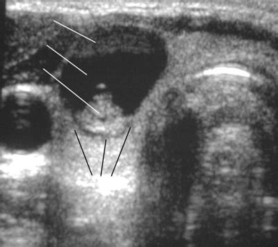 Ultrasound image of thyroid carcinoma | Download Scientific Diagram