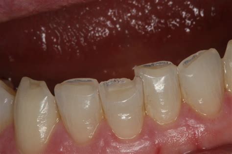 Composite Resin Fillings | Nadim J Jubran DDS PC