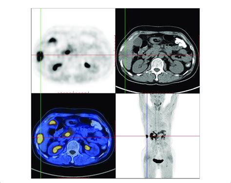 18 F AlF NOTA FAPI 04 PET CT Imaging Of A Female IDC Patient 54 Y