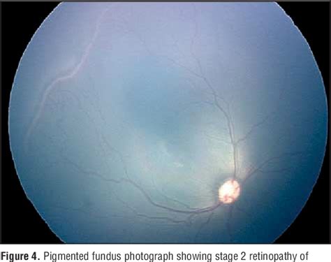 Figure 1 From The International Classification Of Retinopathy Of Prematurity Revisited