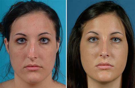 Rhinoplasty Austin Tx Dr Weinfeld