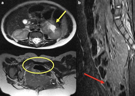 Abdominal Mri Findings Axial T 2 Wi A B Imaging Demonstrating The