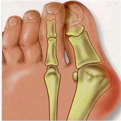 2 Par Gel Grande Dedo Do Pé Separador Hallux Valgus Bunion Corrector