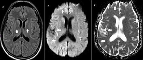 brain mri panel  show hyperintensity  bilateral striatum