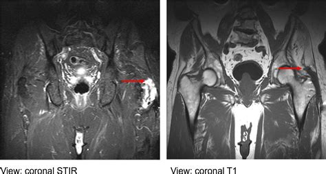 Figure 2 from Nonoperative Approach to Treatment of a Gluteus Medius