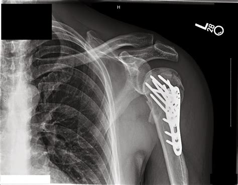 Broken shoulder blade recovery time: 6 Symptoms of a Broken Shoulder ...