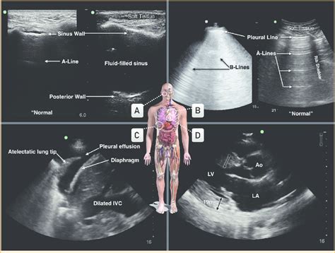 Case 1 Point Of Care Ultrasonographic Images A Normal Maxillary