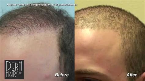 Body Hair Transplant Results - BHT - DermHair Clinic L.A. 1-310-318-1500