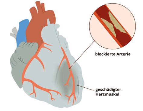 Herzinfarkt Was Passiert Bei Einem Herzinfarkt