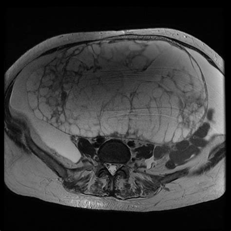 Axial T2 Weighted Image Demonstrates A Large Multilocular Cyst With