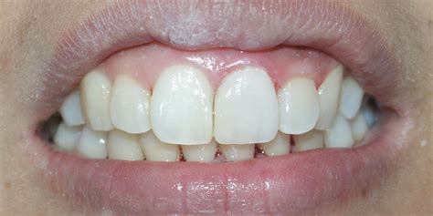 Composite Restorations In Quezon City Asian Sun Dental Clinic