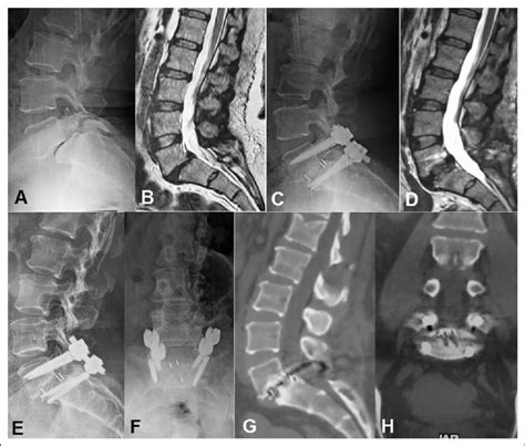 Spondylolisthesis Grades