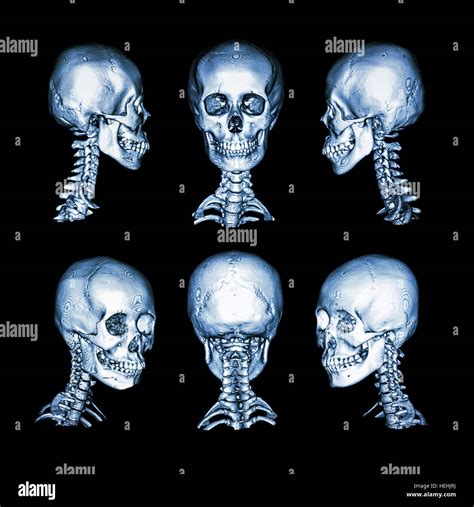 CT Scan And 3D Image Normal Human Skull And Cervical Spine All