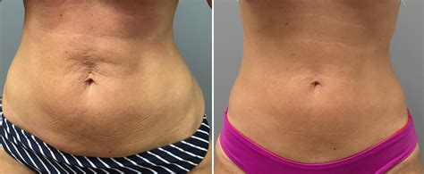 Before After Advanced Skin Care Laser Body Contouring Center