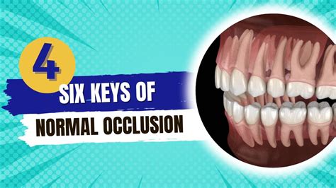 Six Keys Of Normal Occlusion Orthodontics Course Youtube