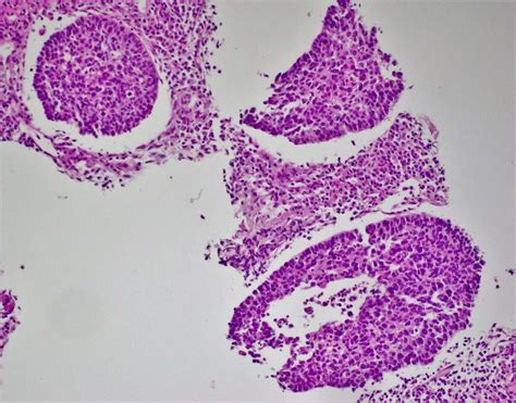 Pathology Outlines Squamous Cell Carcinoma And Variants Hot Sex Picture