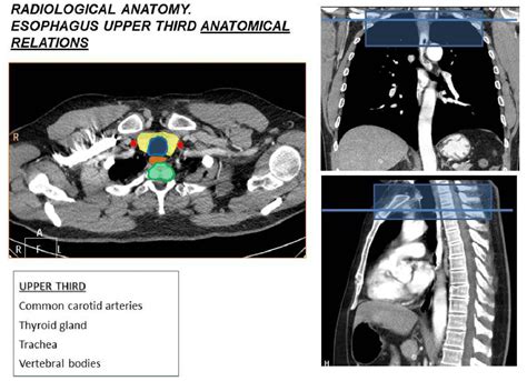 Figure 2 From Esophageal Cancer Anatomical Features Current