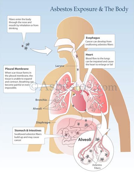 Mesothelioma And Asbestos Images Diagrams Graphs And More