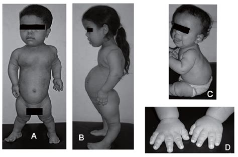 The Characteristic Clinical Features Of Achondroplasia A Exaggerated