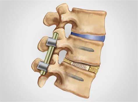 Posterior Lumbar Interbody Fusion Plif In Delhi