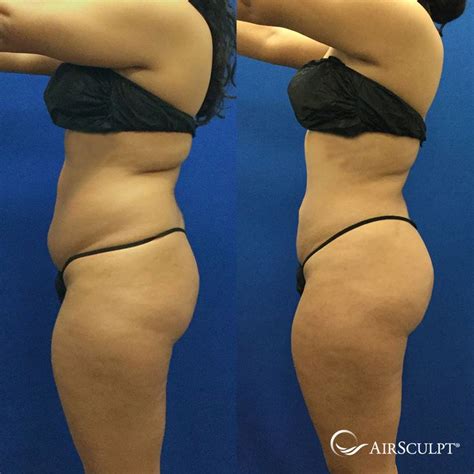 Pin On Airsculpt® Before And After Elite Body Sculpture