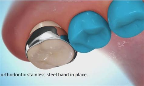 What Are Orthodontic Separators Spacers Clonmel Orthodontics