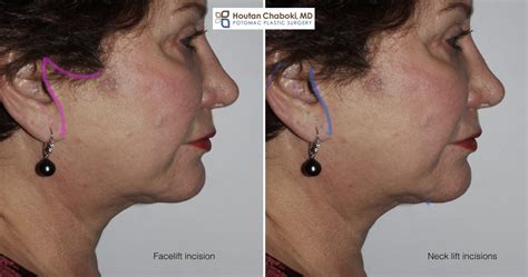 Neck lift vs. Facelift Cosmetic Surgery – Potomac Plastic Surgery