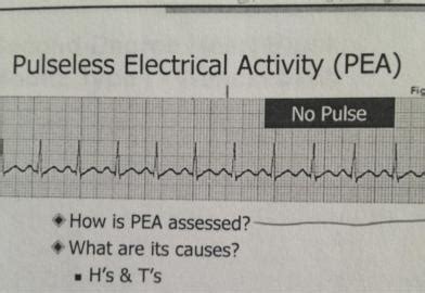 Pulseless Electrical Activity Ecg Strip VERIFIED