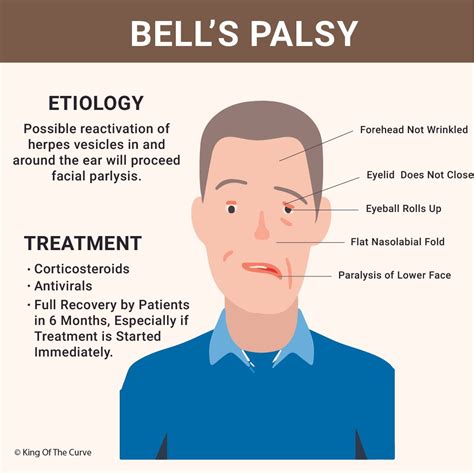bells palsy symptoms   treatment guidelines king