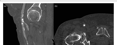 Role Of Computed Tomography In Transcatheter Aortic Valve Implantation