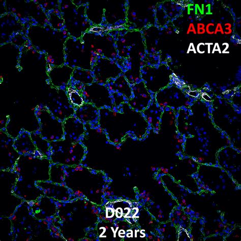 Year Old Human Lung Immunofluorescence And Confocal Imaging Donor