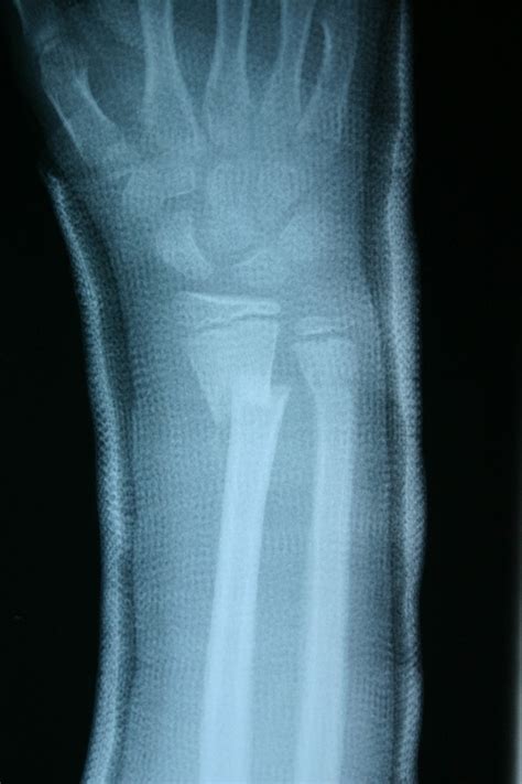 broken-arm-xray – Broken Arm Answers | Symptoms Treatment in Children ...