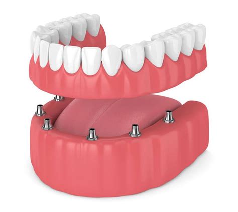 Types Of Dentures Their Costs Complete Denture Care Tips