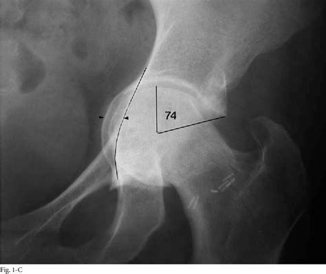 Figure From Protrusio Acetabuli In Marfan Syndrome Age Related